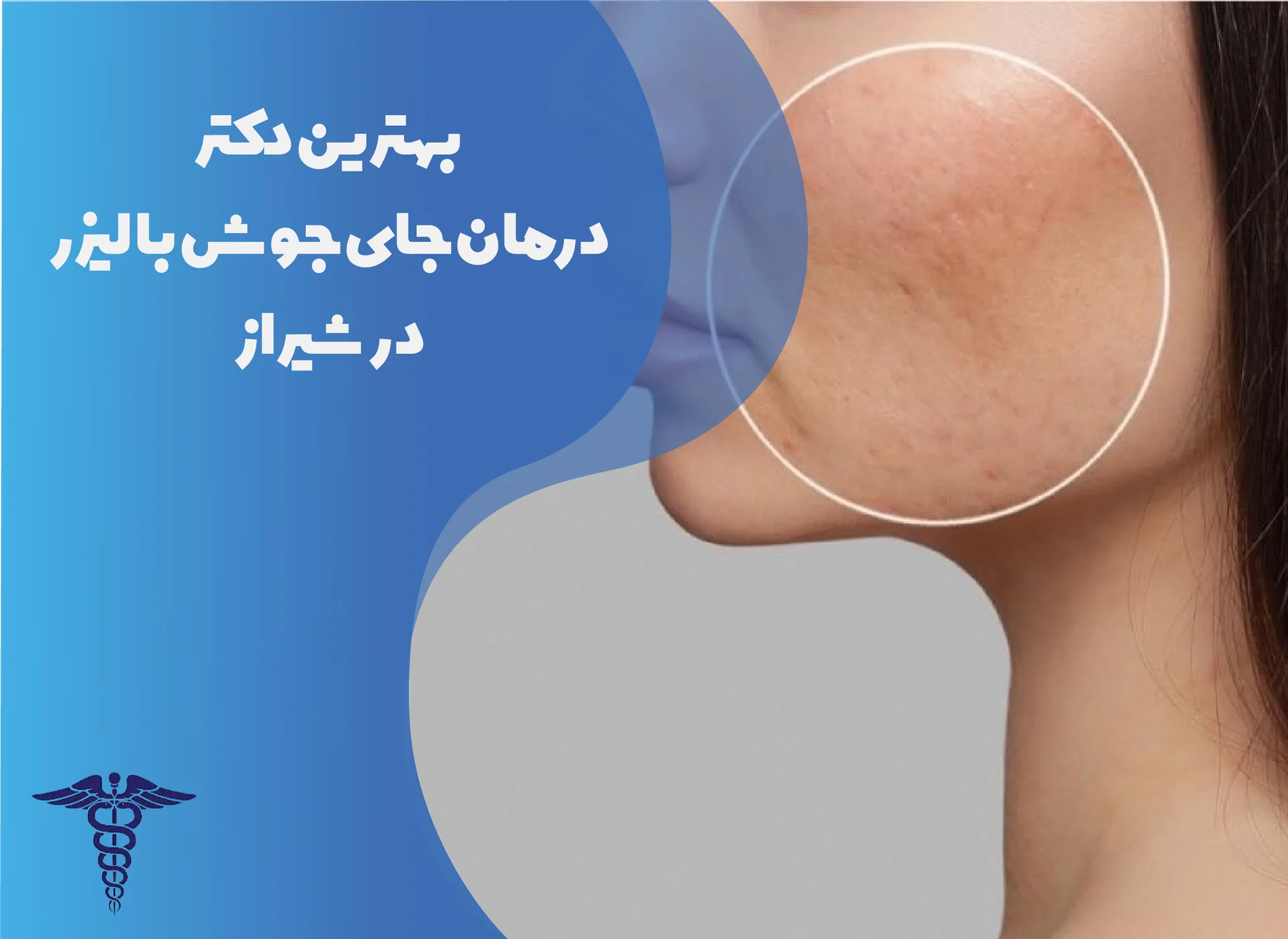 معرفی 10 دکتر برتر درمان جای جوش با لیزر در شیراز – بهترین دکتر جای جوش با لیزر شیراز کیست؟