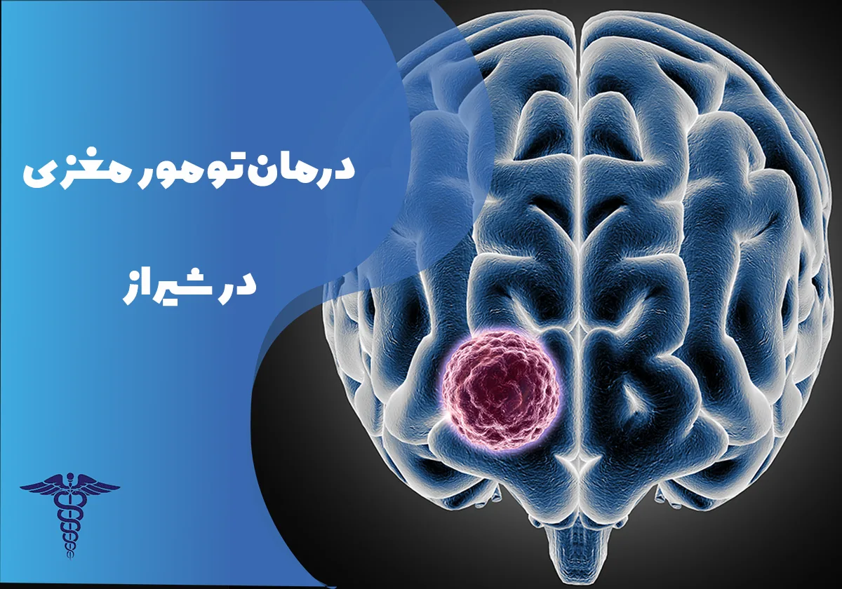 درمان تومور مغزی در شیراز - راهنمای کامل انواع روش های درمان، هزینه و نکات مهم