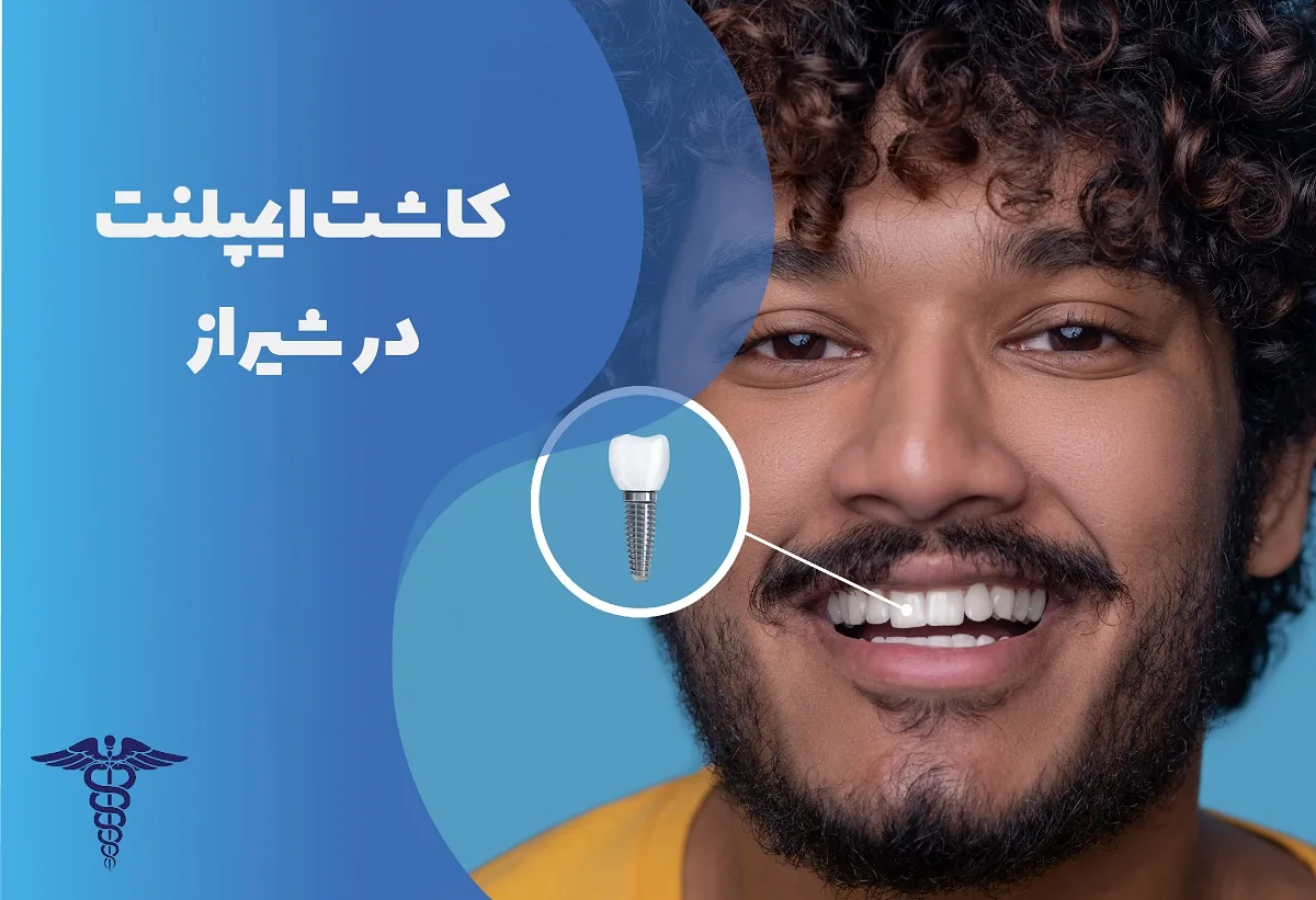 کاشت ایمپلنت در شیراز - راهنمای جامع مراحل، هزینه، مزایا و معایب آن