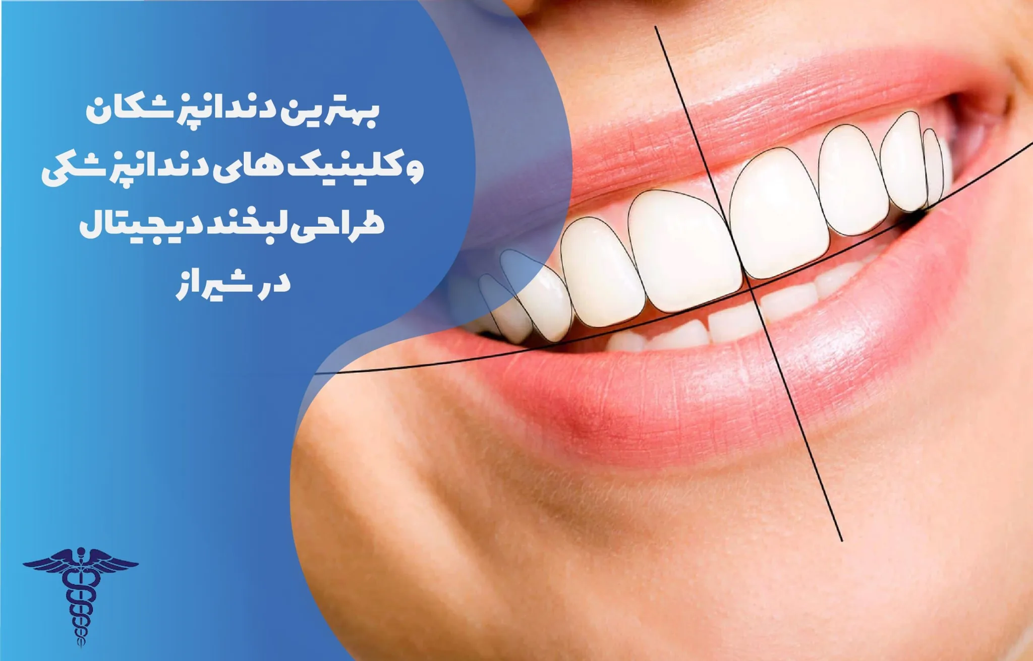 معرفی 14 مرکز طراحی لبخند به روش دیجیتال در شیراز - بهترین دندانپزشک طراحی لبخند دیجیتال شیراز کیست؟