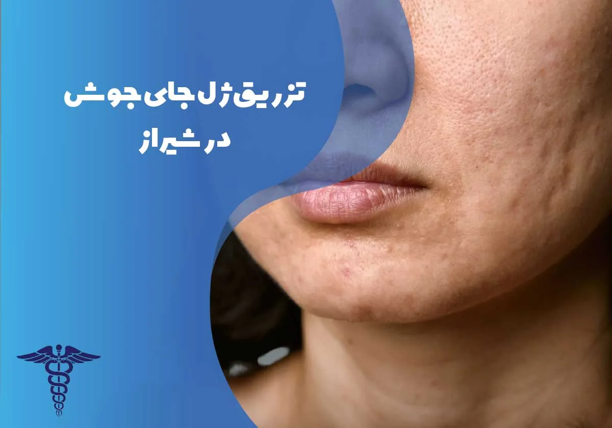 تزریق ژل جای جوش در شیراز - راهنمای کامل معرفی انواع ژل، مراحل تزریق و مراقبت‌های قبل و بعد آن