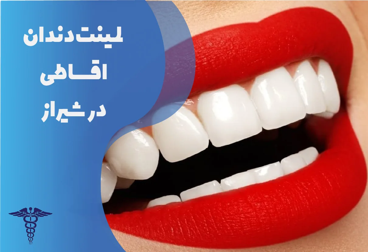 لمینت اقساطی در شیراز | راهنمای جامع شرایط استفاده و پرداخت، مزایا و هزینه