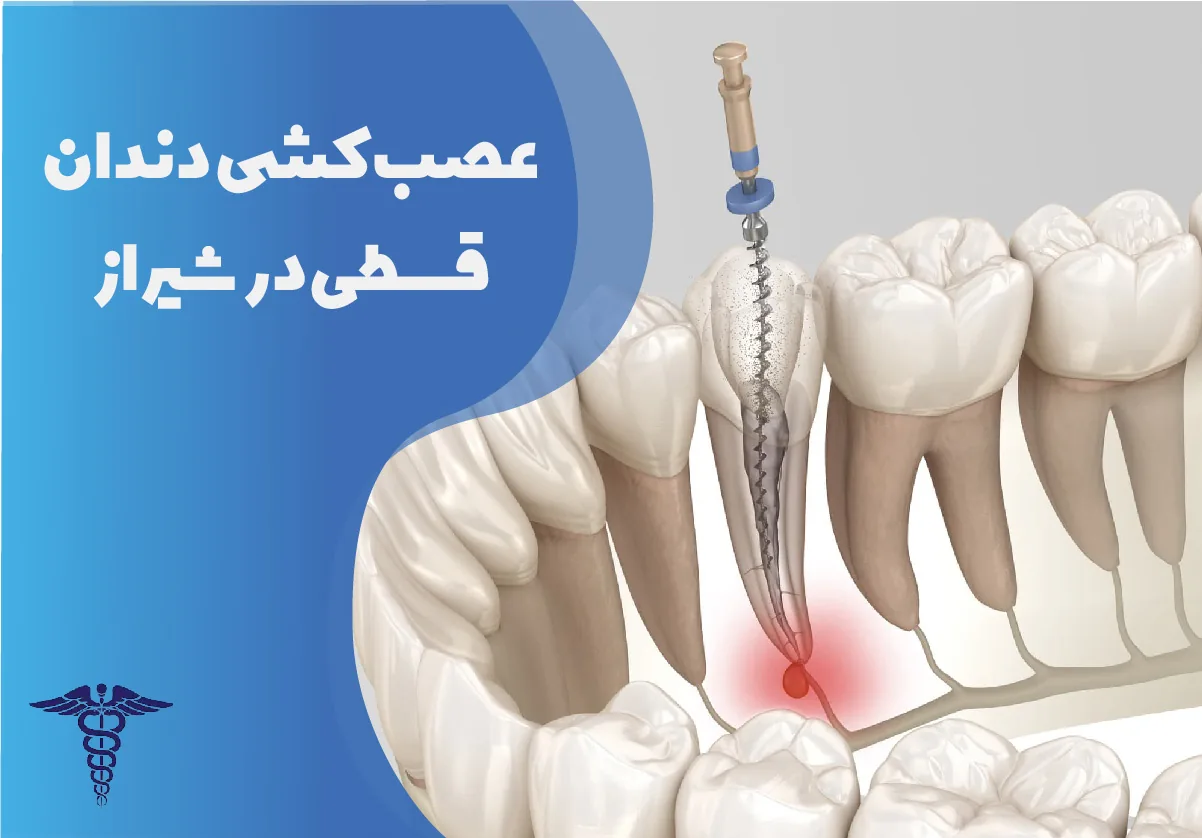 عصب کشی قسطی در شیراز | راهنمای کامل شرایط استفاده و پرداخت، مزایا و هزینه