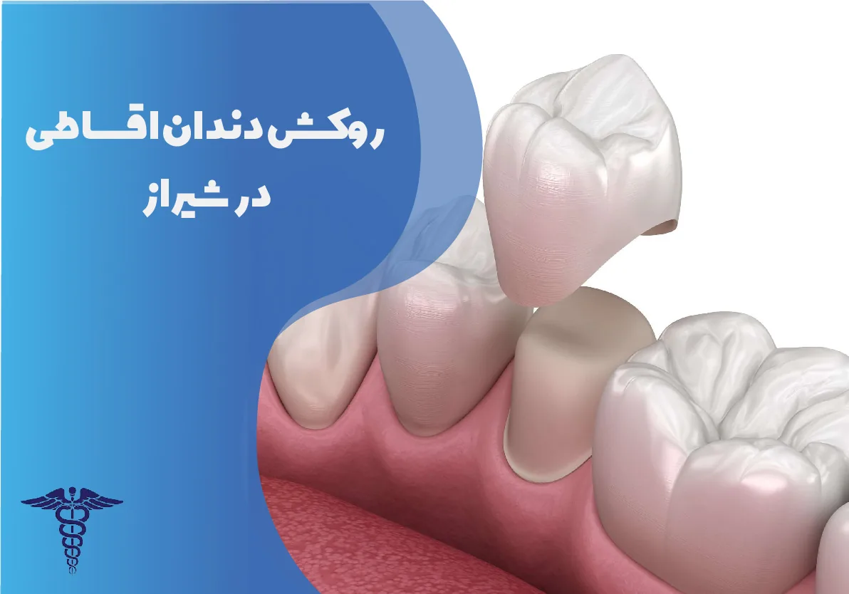 روکش دندان اقساطی در شیراز | راهنمای جامع شرایط استفاده و پرداخت