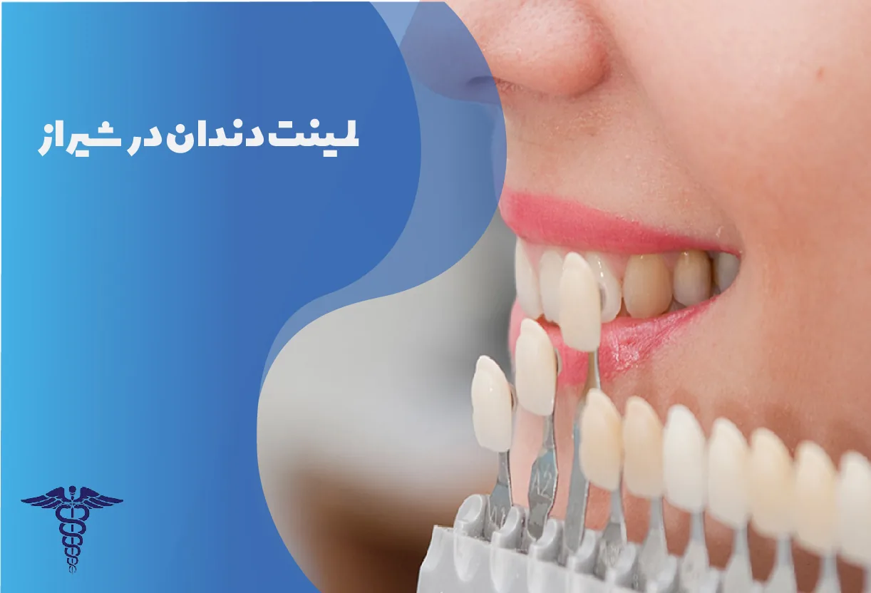 لمینت دندان در شیراز | راهنمای کامل مراحل، هزینه، مزایا و محدودیت ها